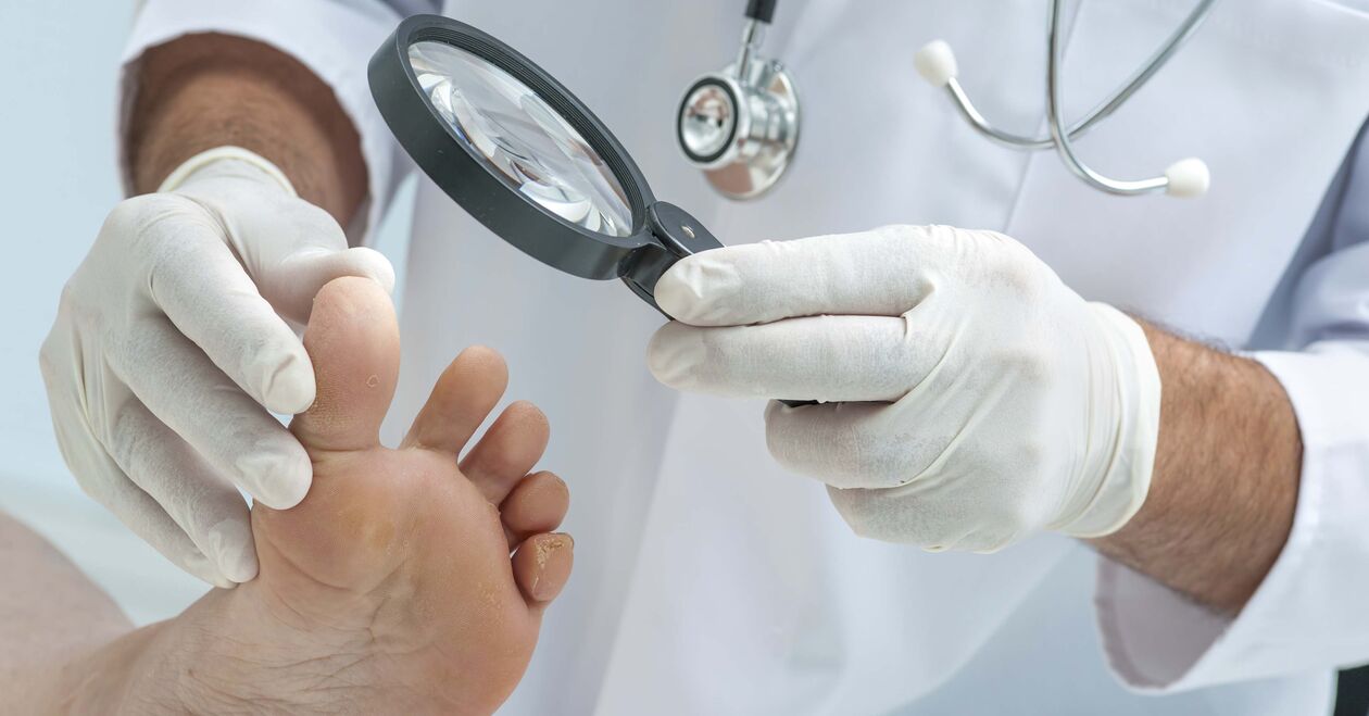 doktor tırnak mantarı için ayakları inceliyor