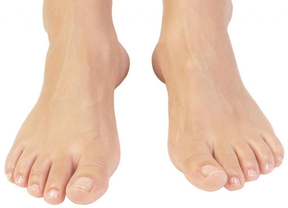 mantar tedavisinden sonra sağlıklı ayak tırnakları