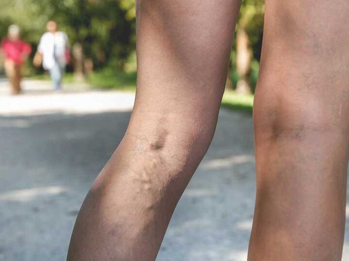 Varisli damarlar ayak mantarı enfeksiyonu için bir risk faktörüdür