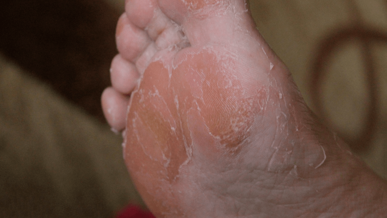 ayak derisi mantarı