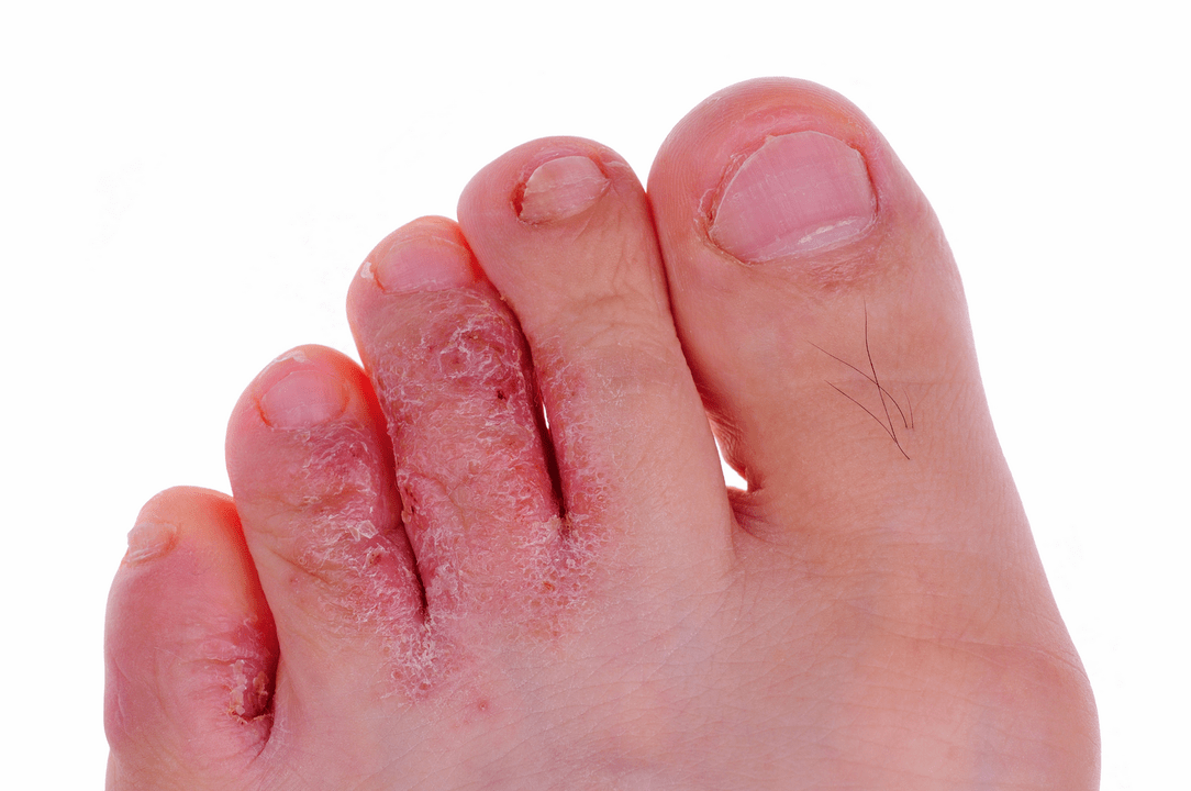ayak parmakları arasındaki derinin mantar enfeksiyonu