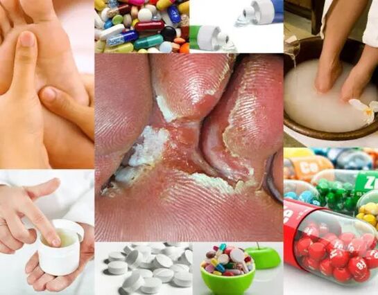 İnterdigital mikoz ve tedavi yöntemleri